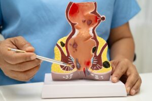 ankara hemoroid doktoru