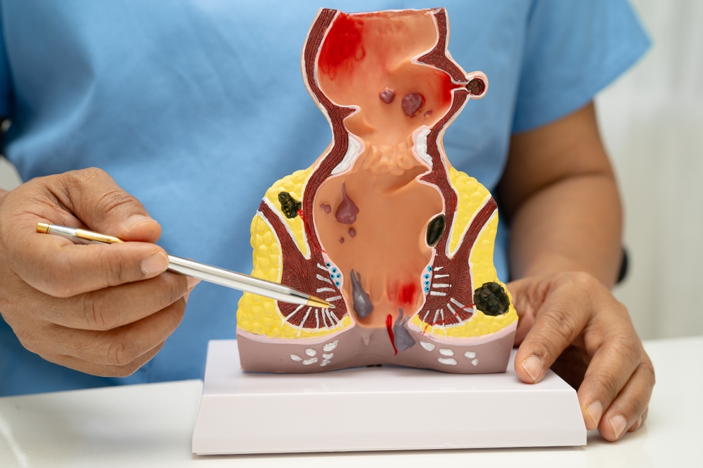 ankara hemoroid doktoru