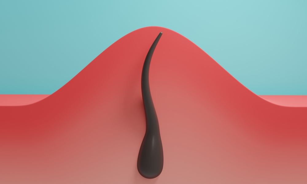 Ankara Kıl Dönmesi: Belirtiler, Tedavi Seçenekleri ve Doktor Seçimi