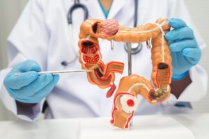 ankara kolon kanseri doktor