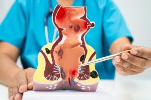 ankara rektum kanseri